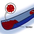 Oggi parliamo di... TROMBOSI VENOSA
